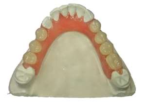 Tandprotese behandling